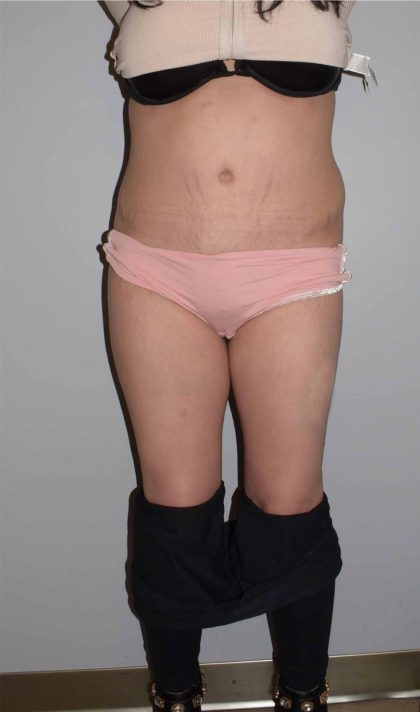 Brazilian Butt Lift Before & After Patient #1624