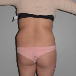 Brazilian Butt Lift Before & After Patient #1624