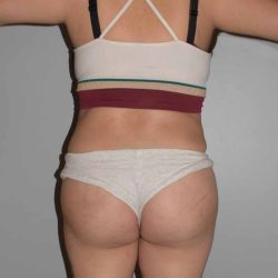 Brazilian Butt Lift Before & After Patient #1624