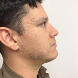 Morpheus8 Before & After Patient #1671