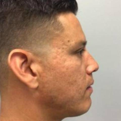 Morpheus8 Before & After Patient #1671